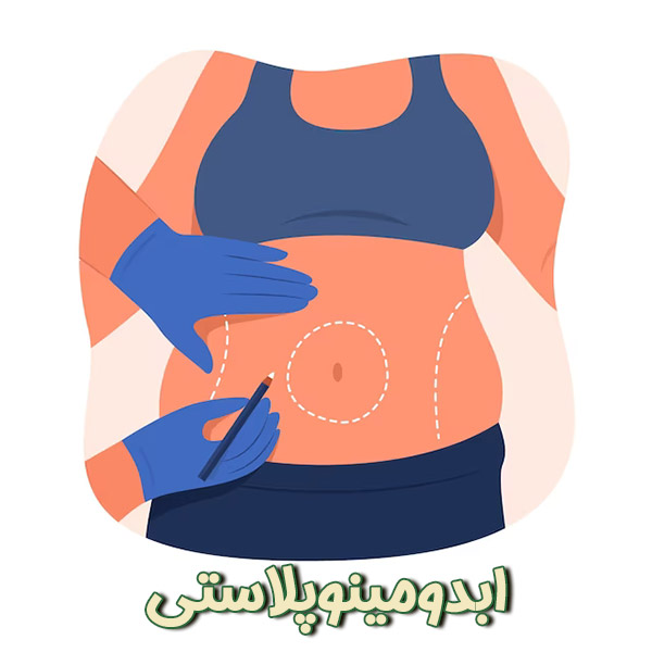 ابدومینوپلاستی - دکتر پروین محمدی