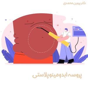 ابدومینوپلاستی - دکتر پروین محمدی