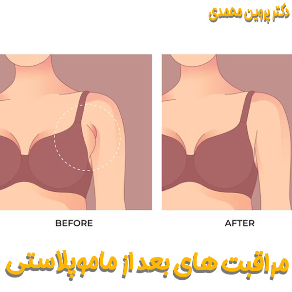 مراقبت های بعد از ماموپلاستی - دکتر پروین محمدی