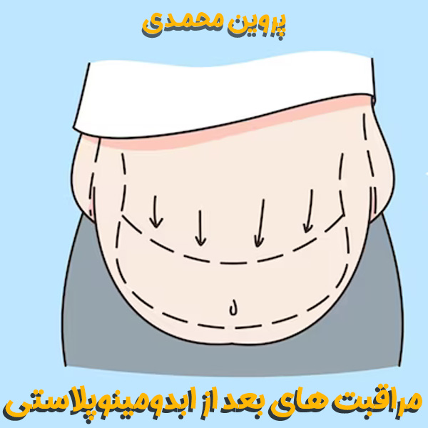 مراقبت های بعد از ابدومینوپلاستی - دکتر پروین محمدی