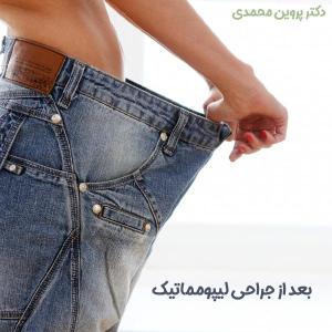 مراقبت های بعد از لیپوماتیک در اهواز - دکتر محمدی