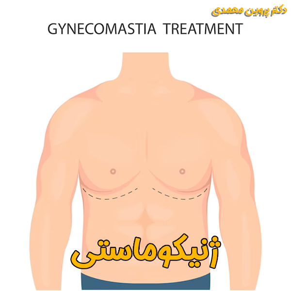 ژنیکوماستی - دکتر پروین محمدی
