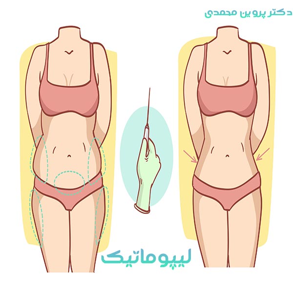 لیپوماتیک_دکتر پروین محمدی