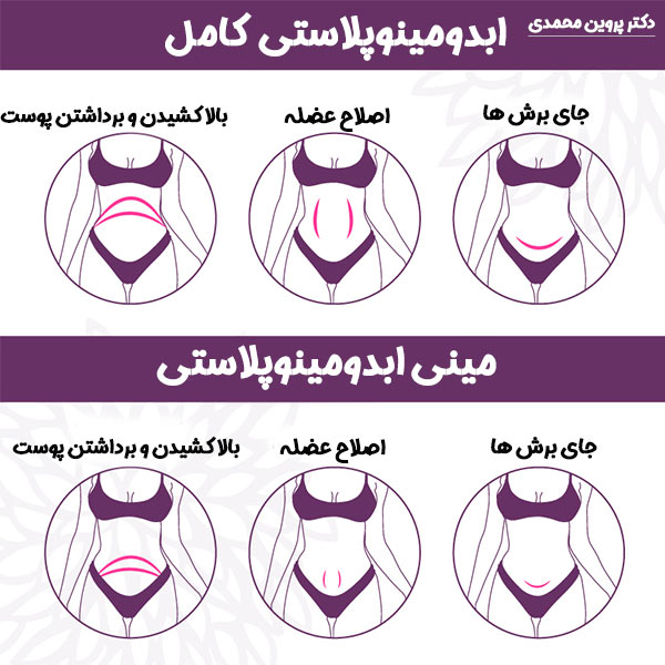 ابدومینوپلاستی - دکتر پروین محمدی