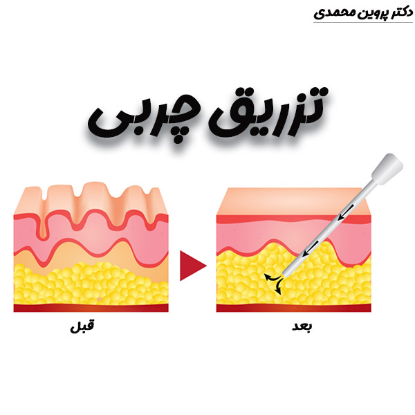 تزریق چربی -دکتر پروین محمدی
