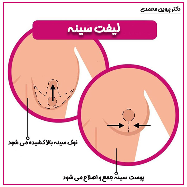 لیفت سینه - دکتر پروین محمدی