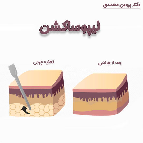 لیپوساکشن -دکتر پروین محمدی