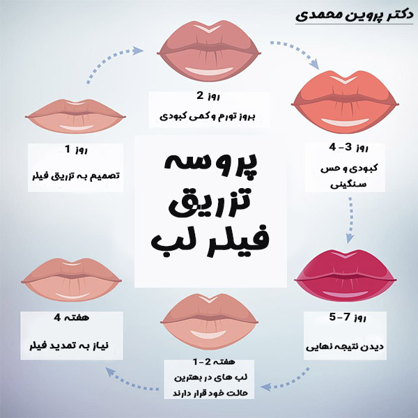 تزریق ژل لب در اهواز -دکتر پروین محمدی