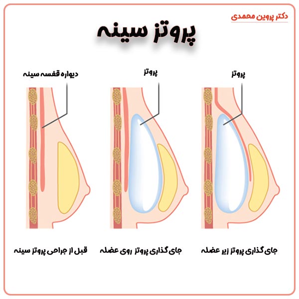 پروتز سینه