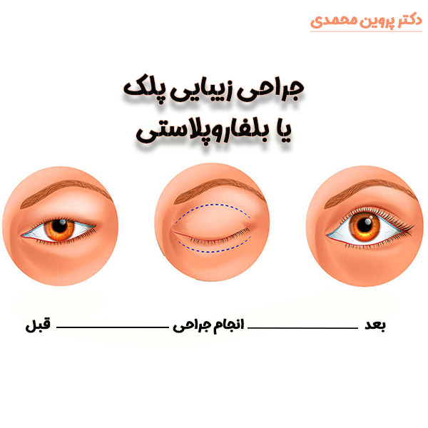 جراحی پلک- دکتر پروین محمدی